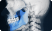Chirurgie orthognathique